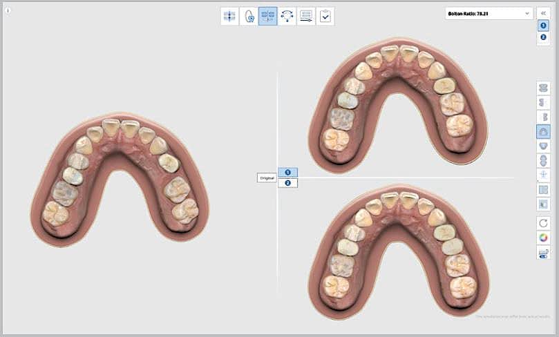 Medit Ortho Simulation - Visualisierung möglicher Ergebnisse einer kieferorthopädischen Behandlung